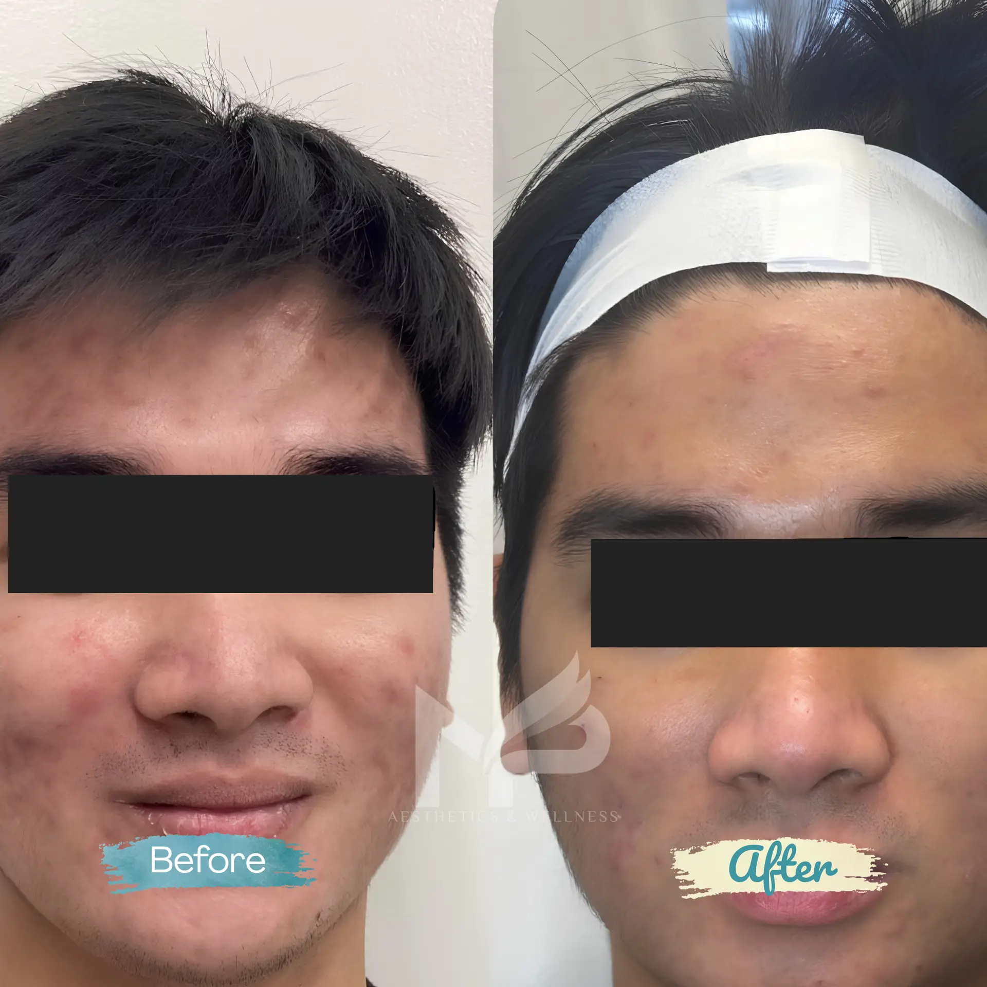 Chemical Peel + Microneedling Result