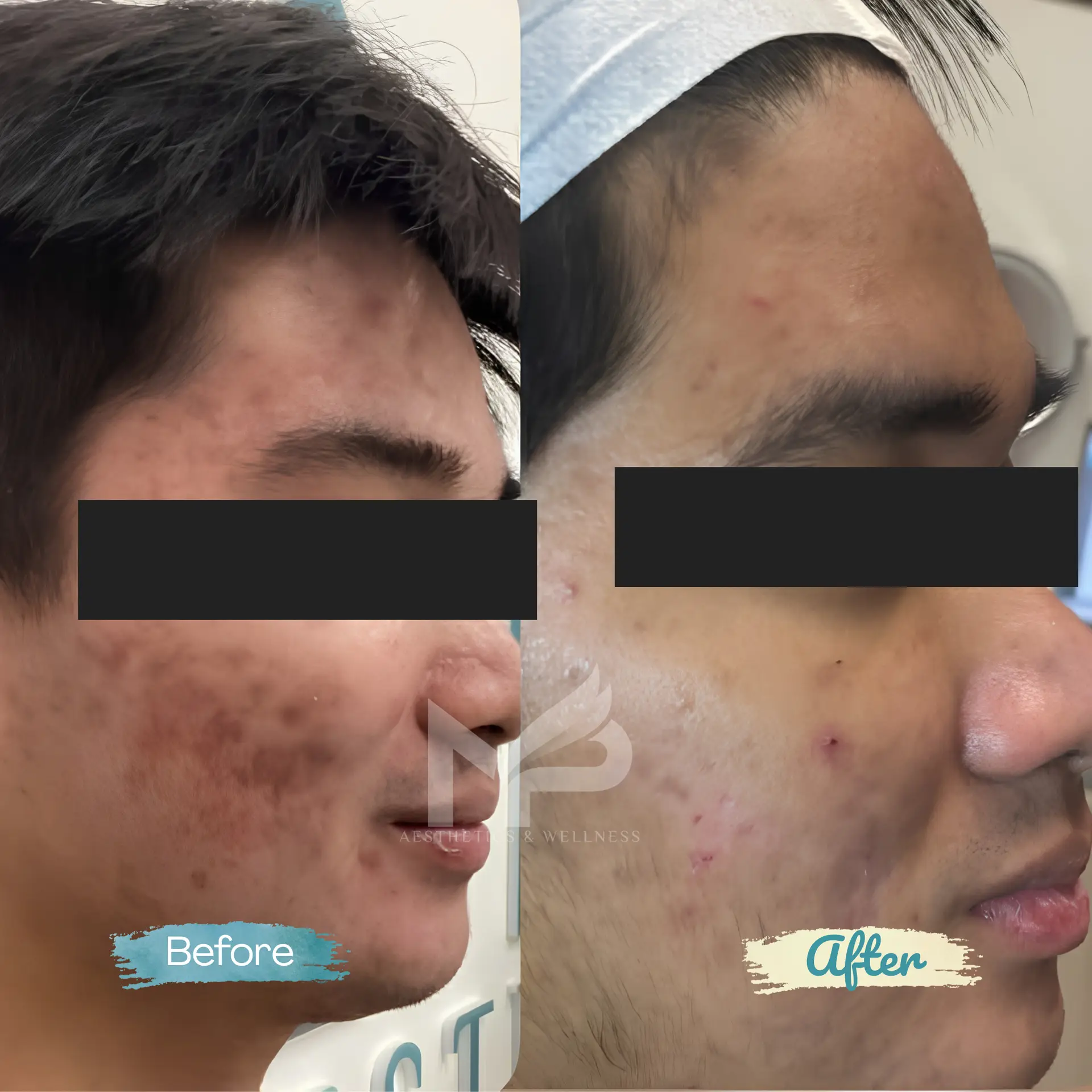 Chemical Peel + Microneedling Result