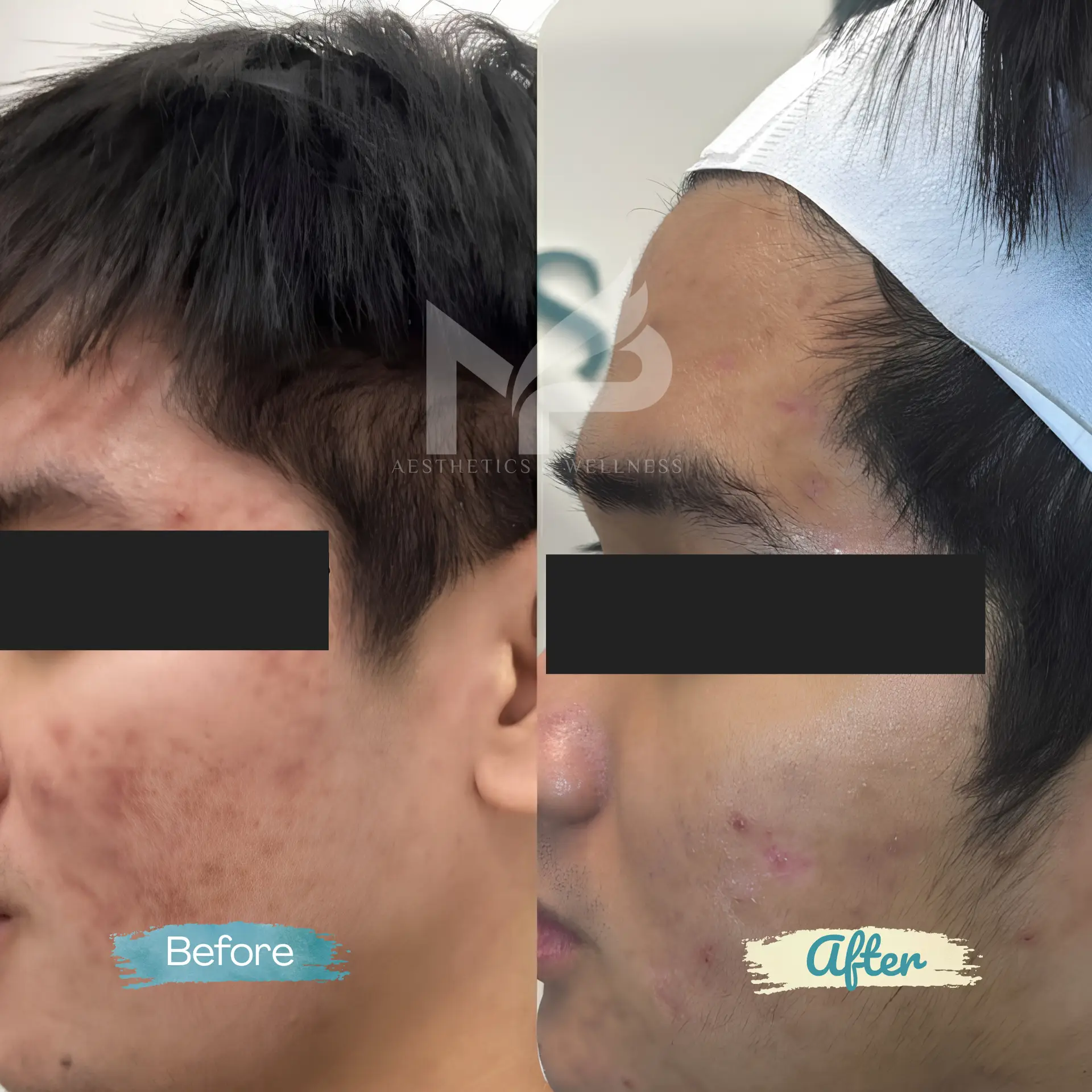 Chemical Peel + Microneedling Result