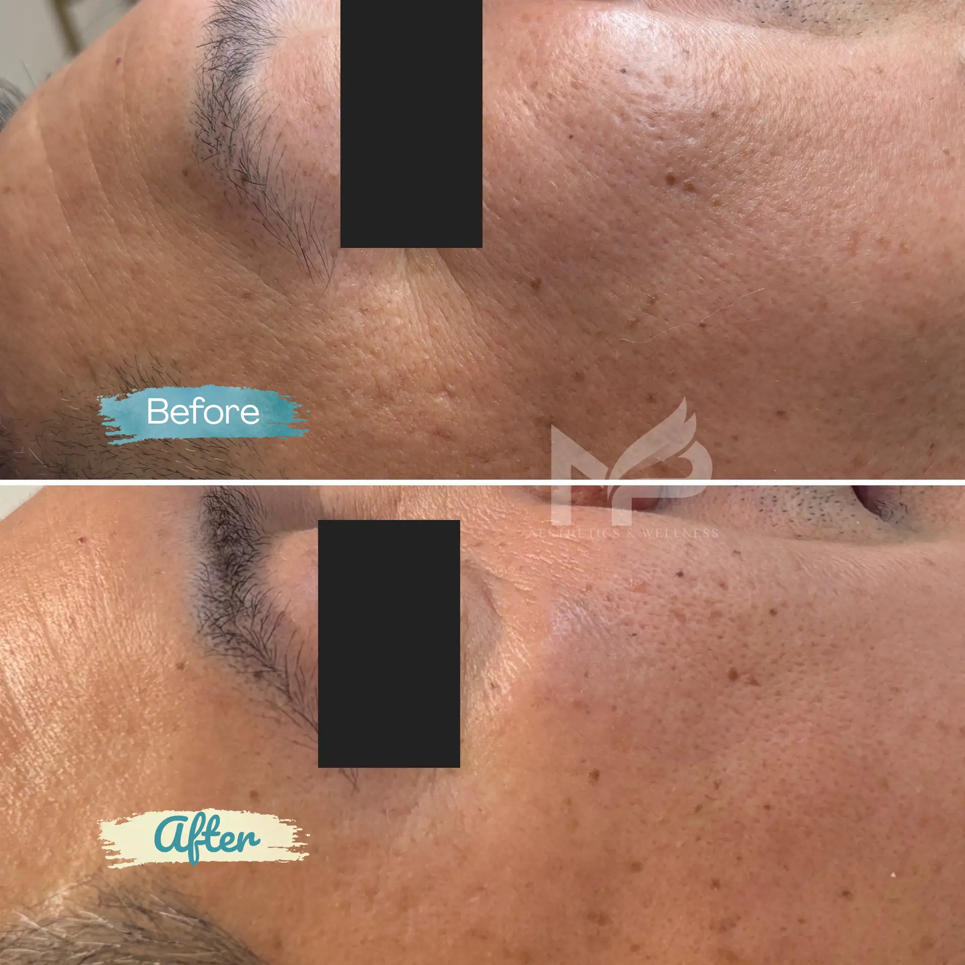 Rejuran Result