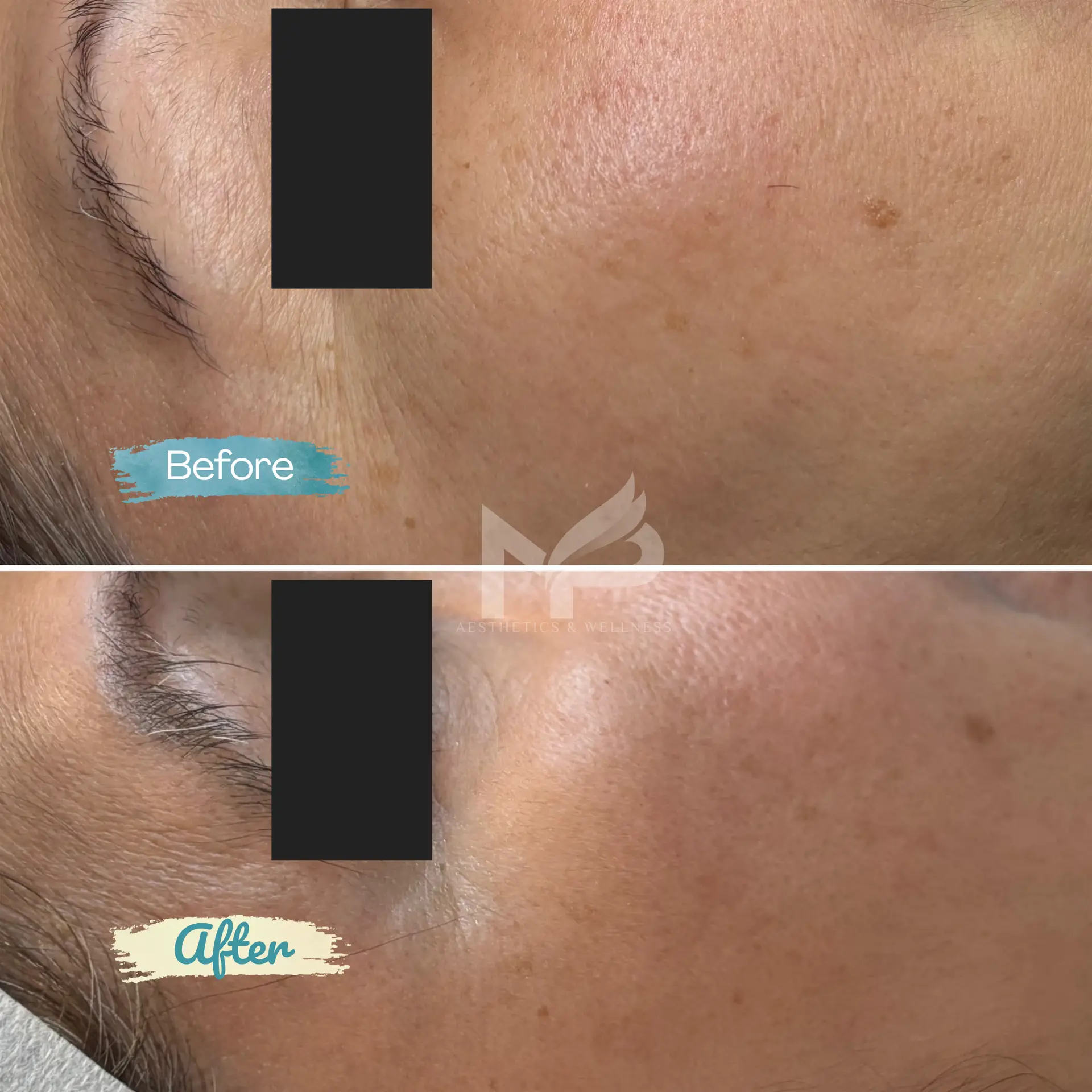 Rejuran Result