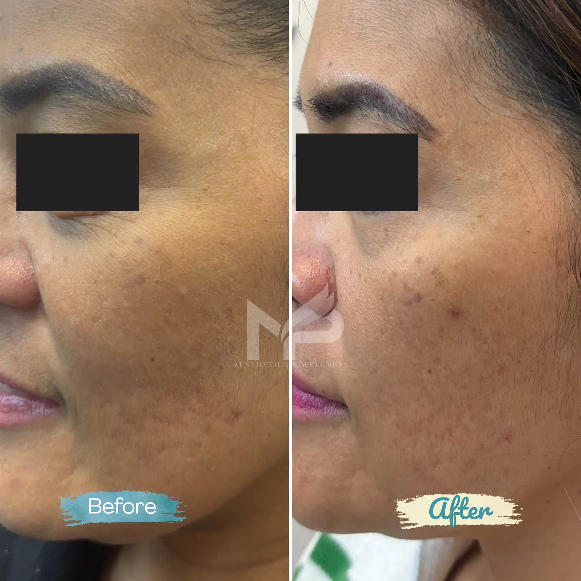 Rejuran Result